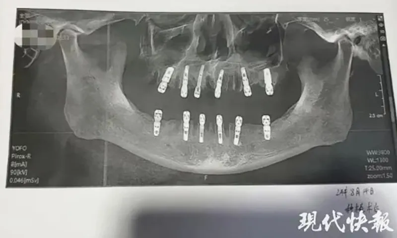 Nhổ 23 cái răng, cấy 12 implant cùng lúc, sau 13 ngày tử vong