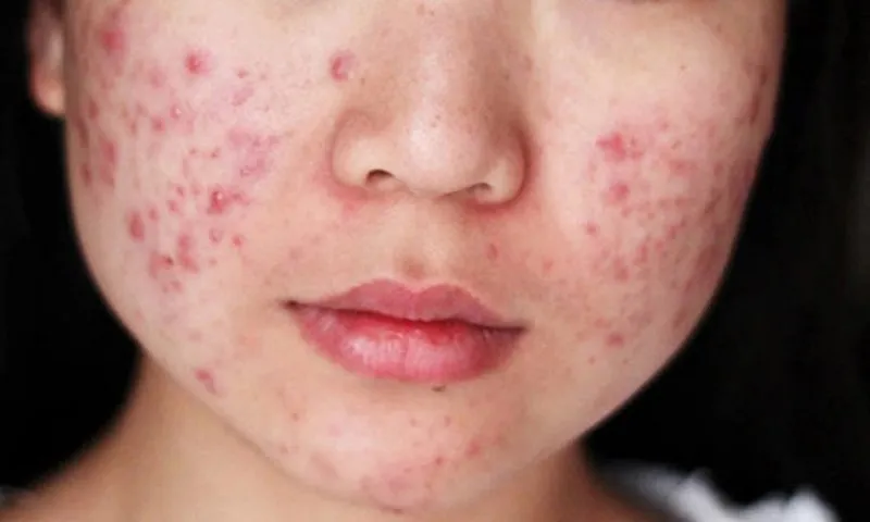 Nhập viện sau khi dùng bộ sản phẩm trị mụn 20 triệu đồng