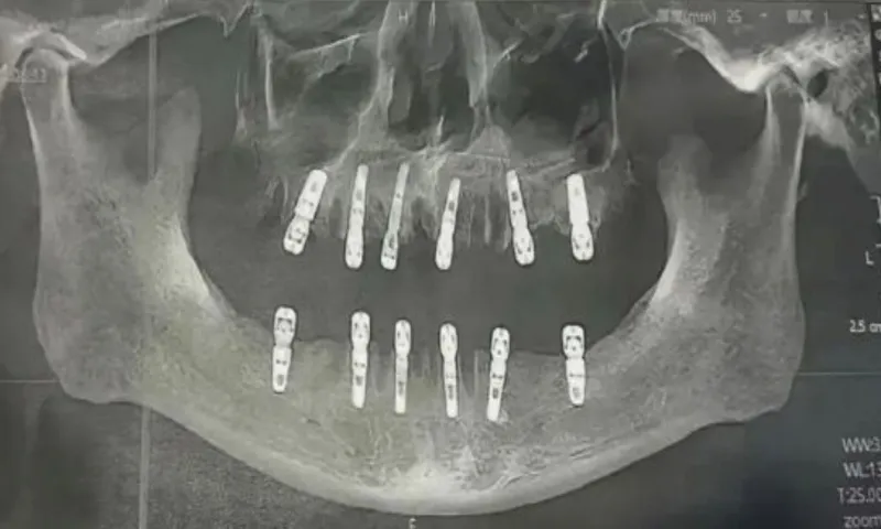 cardiac-arrest-teeth-extracted-c