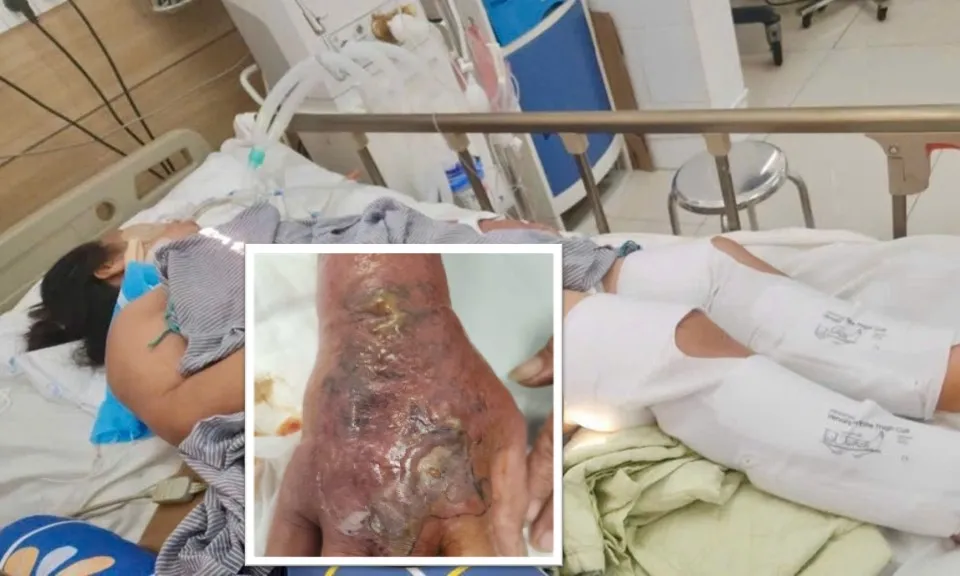 Gần chục người bị thương do rắn cắn trong đợt bão số 3