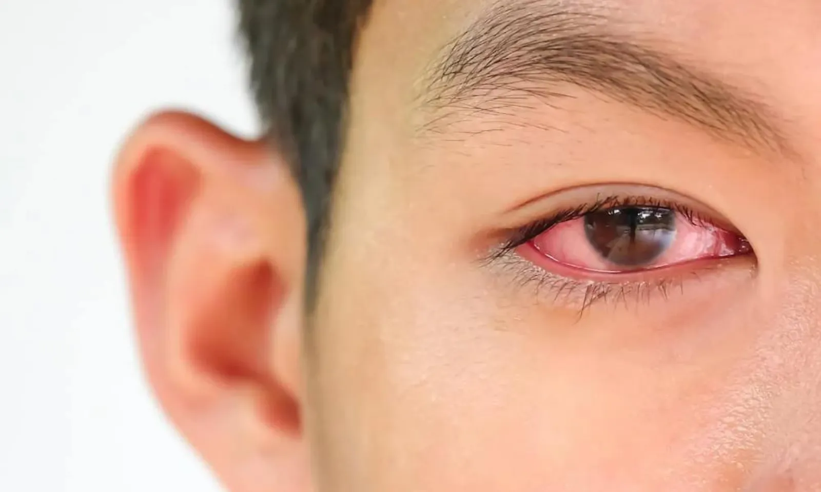 Nguy cơ bùng phát dịch đau mắt mùa bão lũ