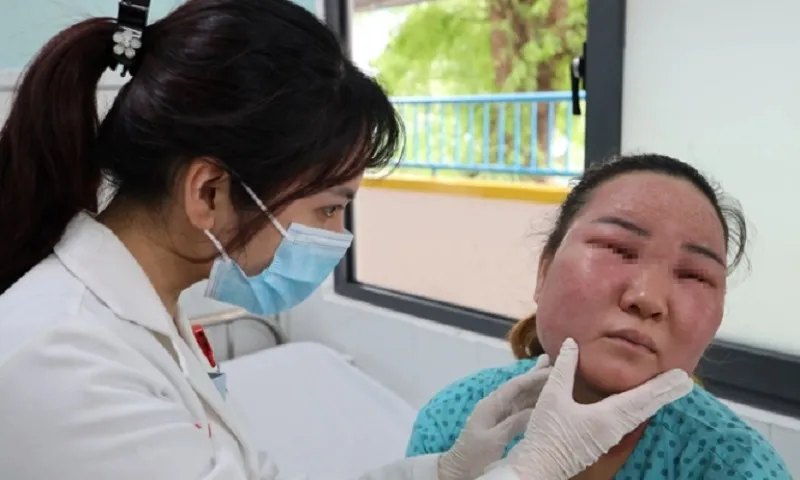 Người phụ nữ nhập viện sau khi tự Peel da tại nhà