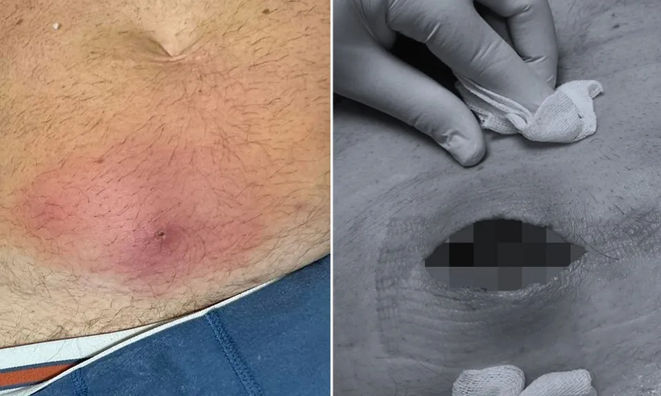 Người đàn ông bị thủng bụng chỉ vì vết cắn nhỏ của một con nhện