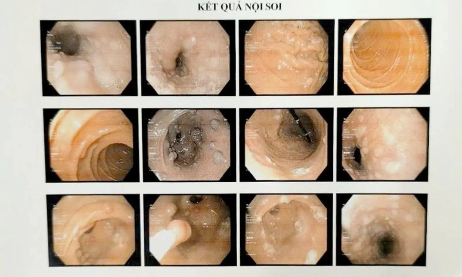 voh-benh-lien-cau-lon-la-gi-lay-sang-nguoi-qua-con-duong-nao-thumb