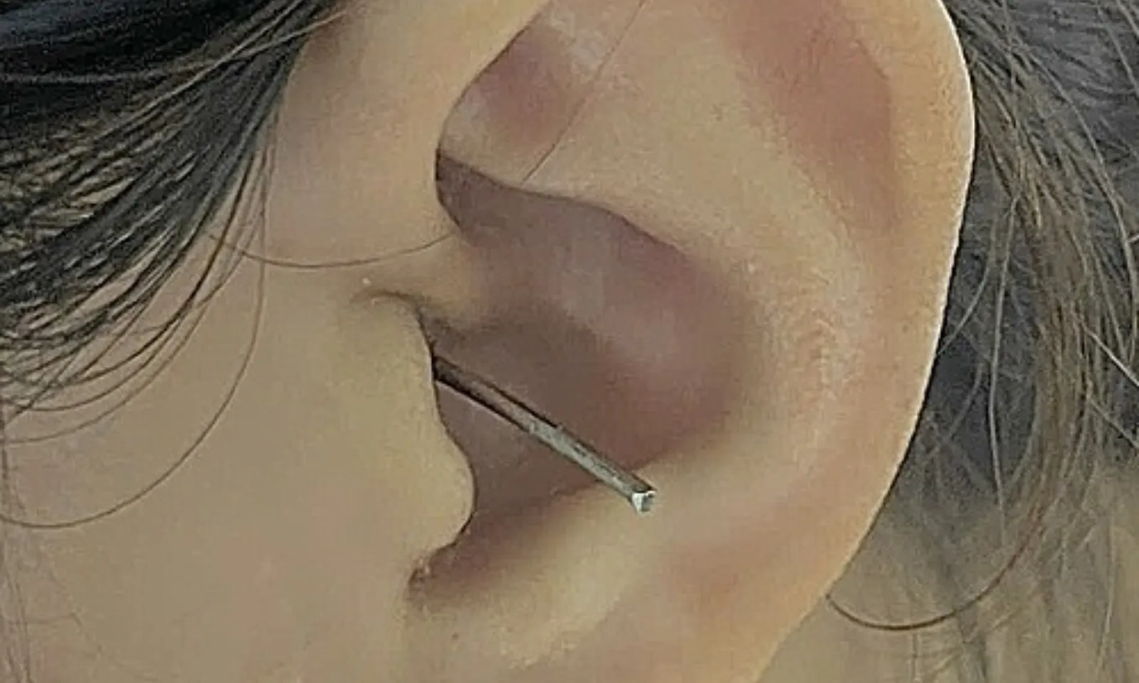 Nữ bệnh nhân bị dụng cụ lấy ráy tai xuyên thủng màng nhĩ