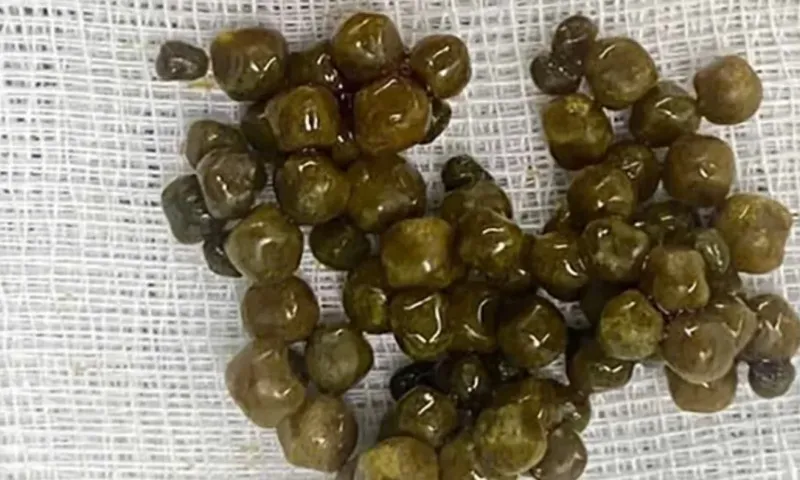 Lấy hơn 50 viên sỏi túi mật ở nam thanh niên, cảnh báo về thói quen của nhiều người trẻ 