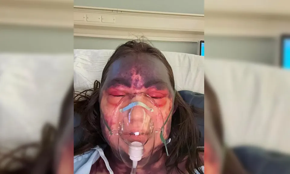 Một người phụ nữ bị mù và bầm tím toàn thân sau khi tiêm 3 loại vaccine cùng lúc