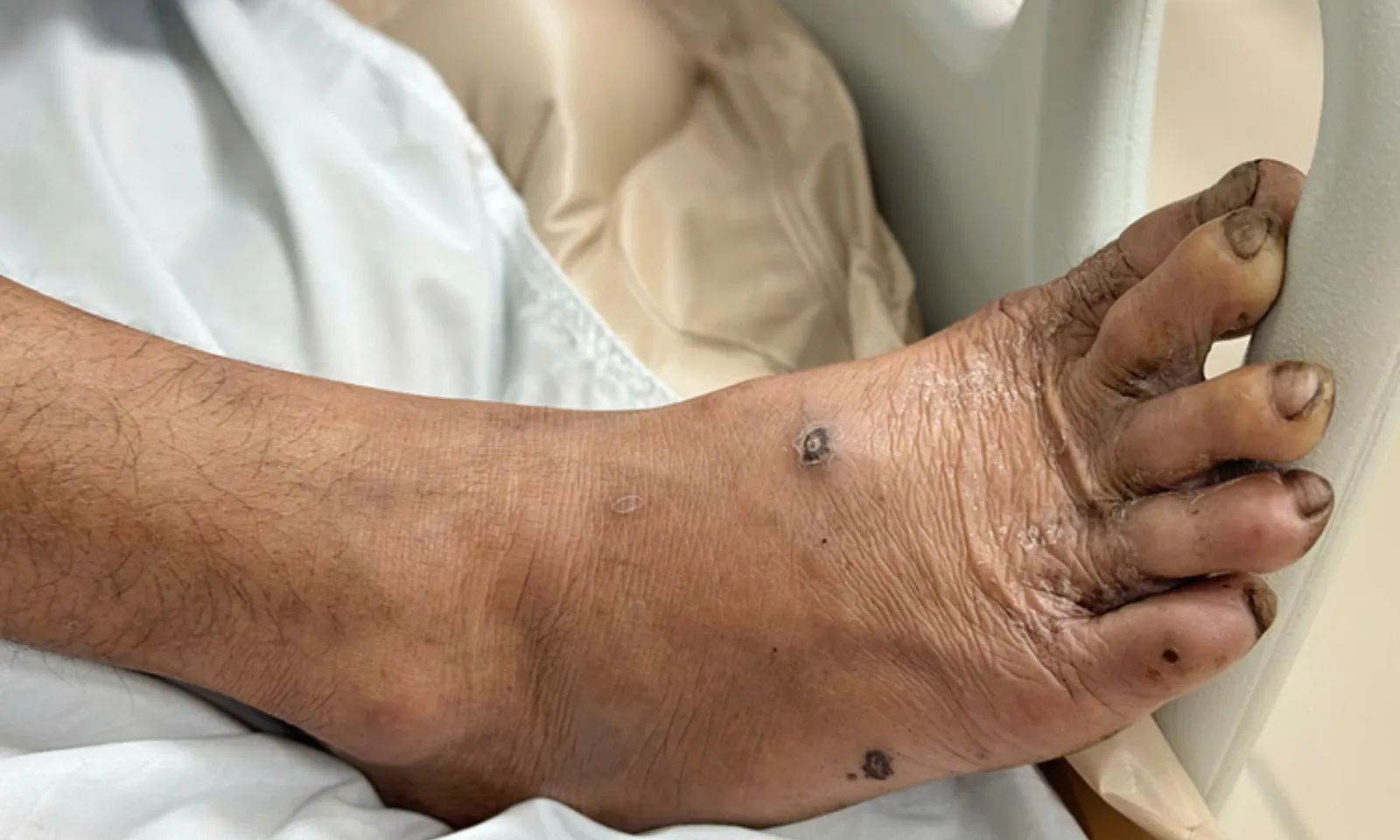 Người đàn ông suýt mất mạng vì vết thương nhỏ do viên gạch rơi trúng chân