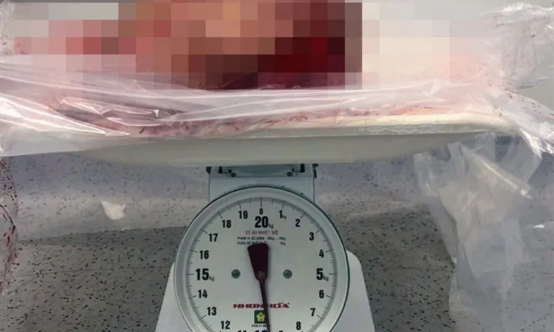 Cắt khối u vú khủng, nặng gần 10kg cho một phụ nữ 
