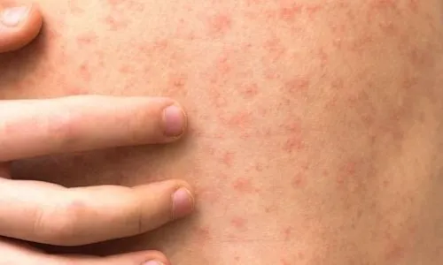 measles-symptoms-gty-mz-20-221123-1669221894974-hpembed-3x2-992-5923