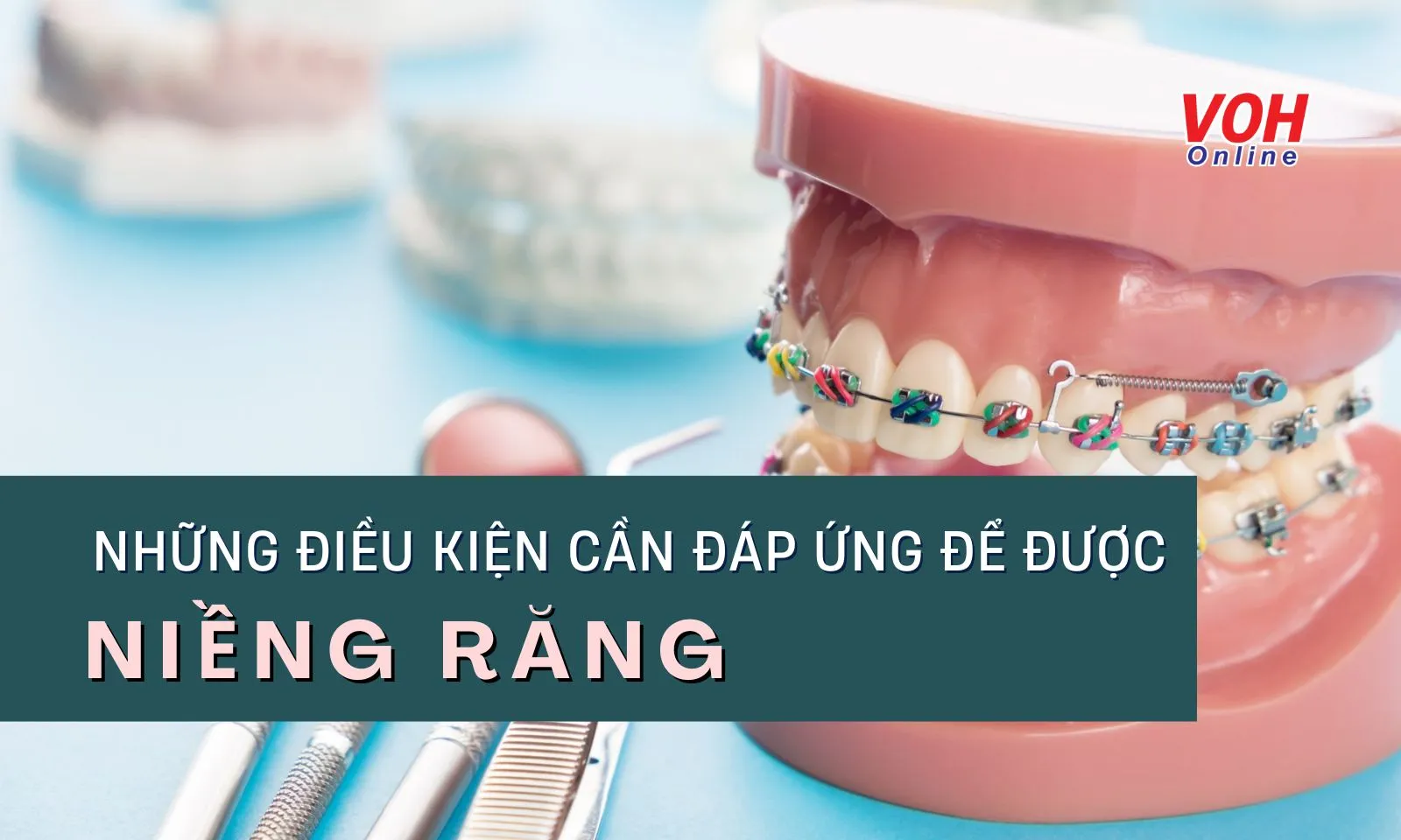 4 điều kiện để được niềng răng