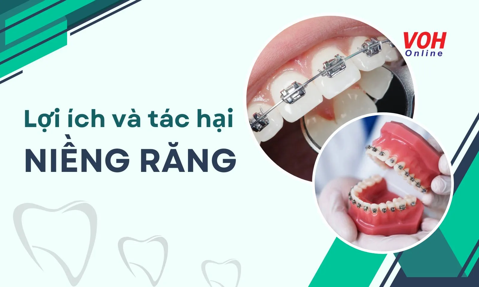 Lợi ích và tác hại của niềng răng mà bạn có nguy cơ gặp phải