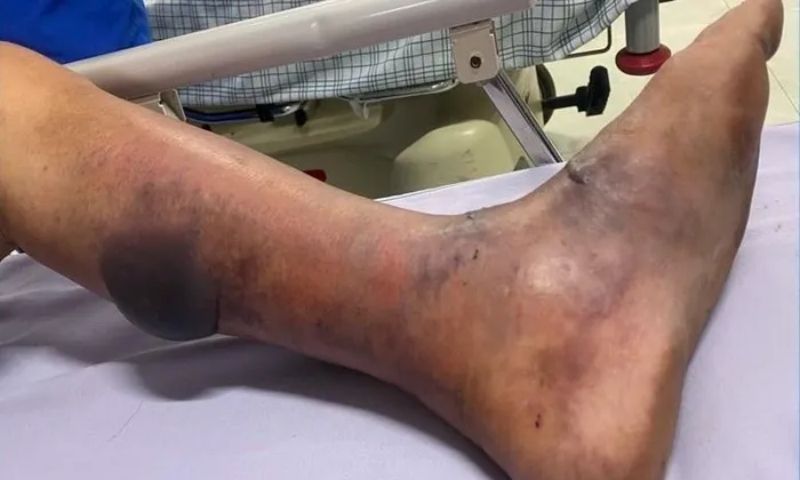 Cảnh báo nguy hiểm: Người đàn ông nhiễm liên cầu lợn sau khi ăn tiết canh