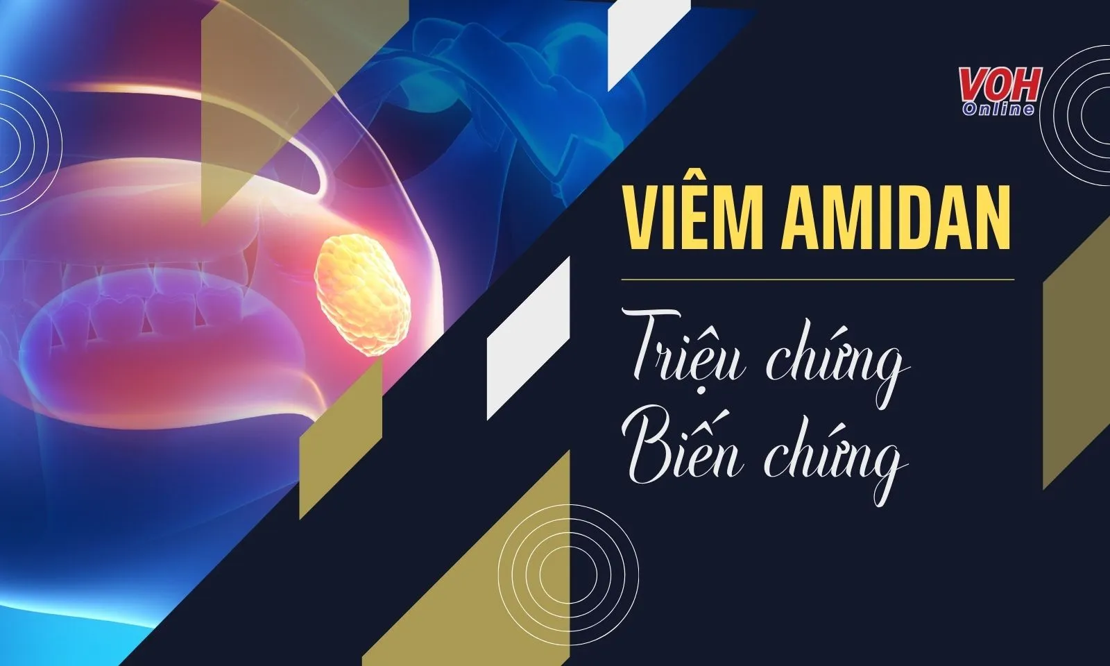 Viêm amidan: Triệu chứng và biến chứng nguy hiểm