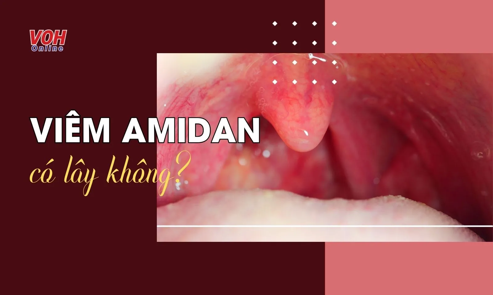 Viêm amidan có lây không? Vì sao người bệnh bị ngưng thở khi ngủ?