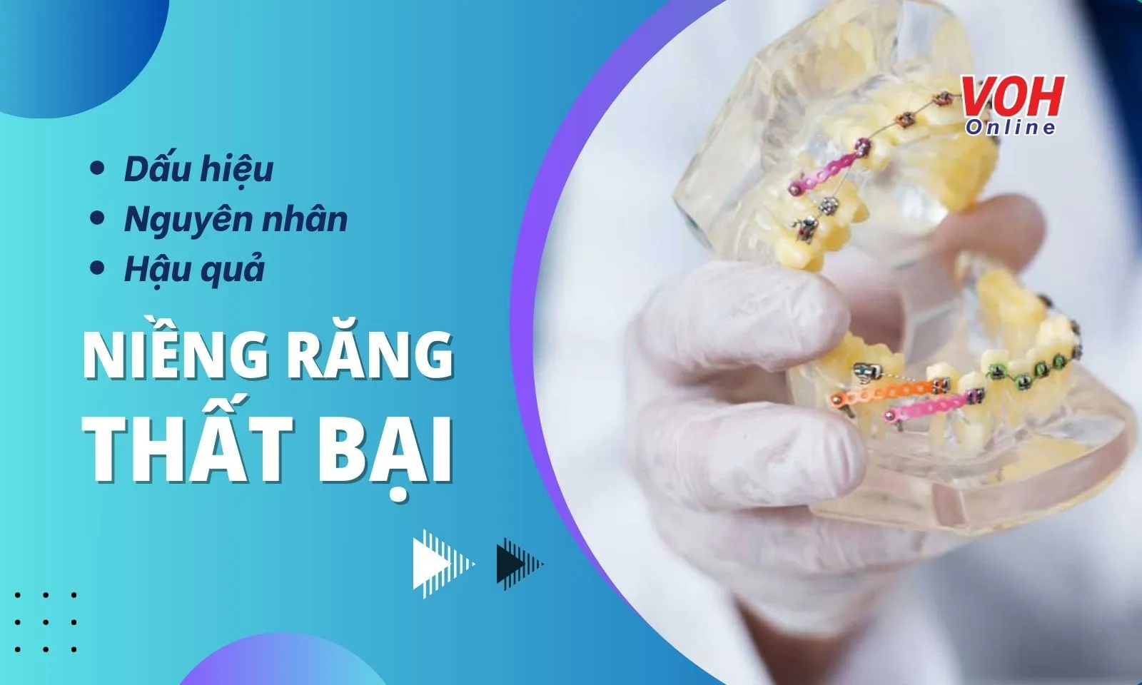 Niềng răng thất bại: Dấu hiệu, nguyên nhân và hậu quả