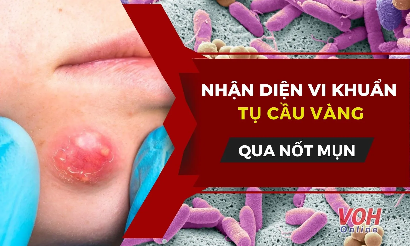 Cách xác định nhiễm khuẩn tụ cầu vàng từ nốt mụn nhọt