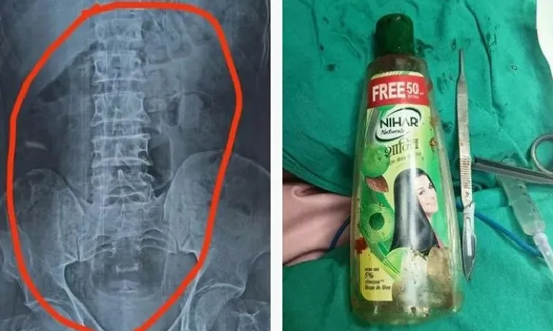 Người đàn ông gây “sốc” khi có trong bụng dị vật là một chai nước