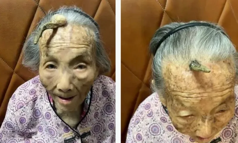 Chiếc sừng trường thọ kỳ lạ trên trán cụ bà 107 tuổi