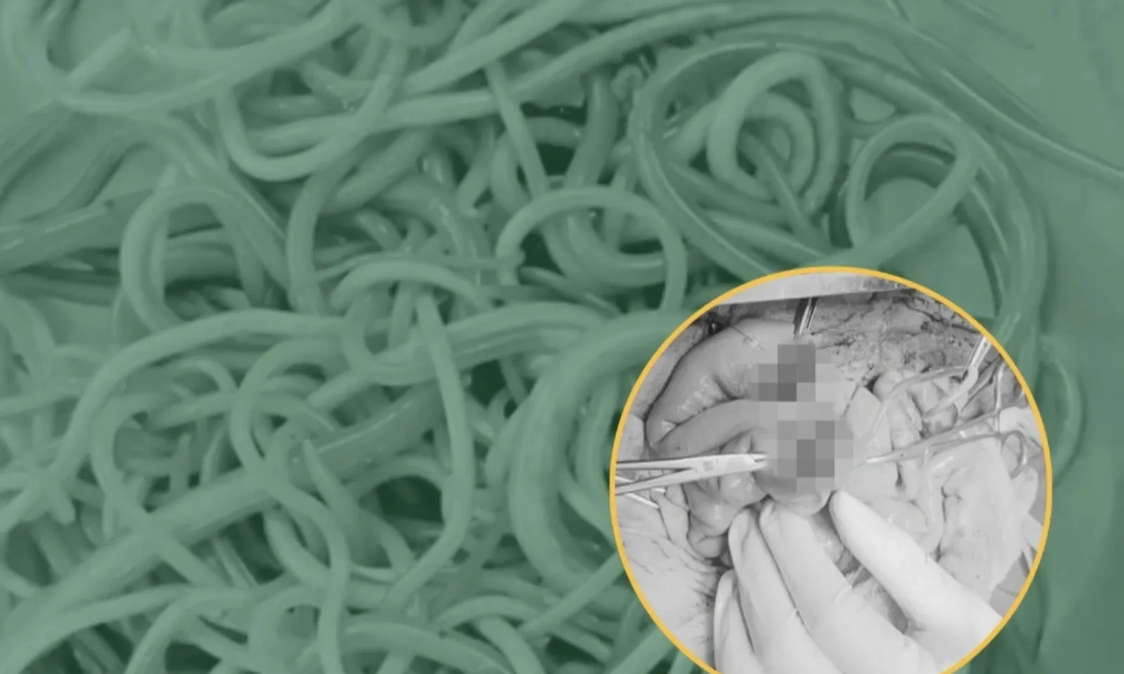 Hơn 100 con giun đũa trong ruột, bé trai nguy kịch vì tắc ruột