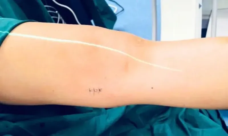 Bé trai 7 tuổi gãy xương đùi được phẫu thuật hiện đại, nhanh hồi phục