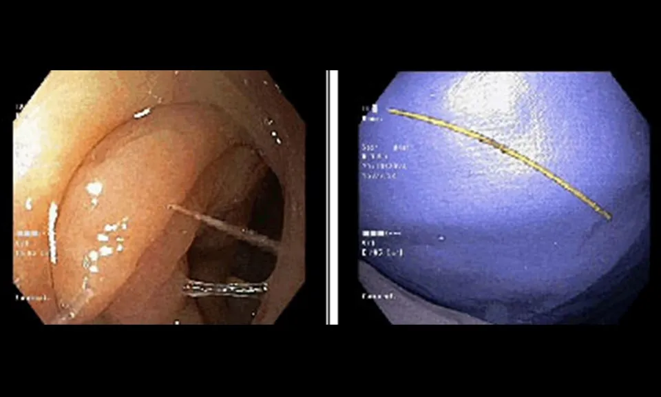 Cứu bệnh nhân bị chiếc tăm dài 7cm đâm ngang lòng đại tràng