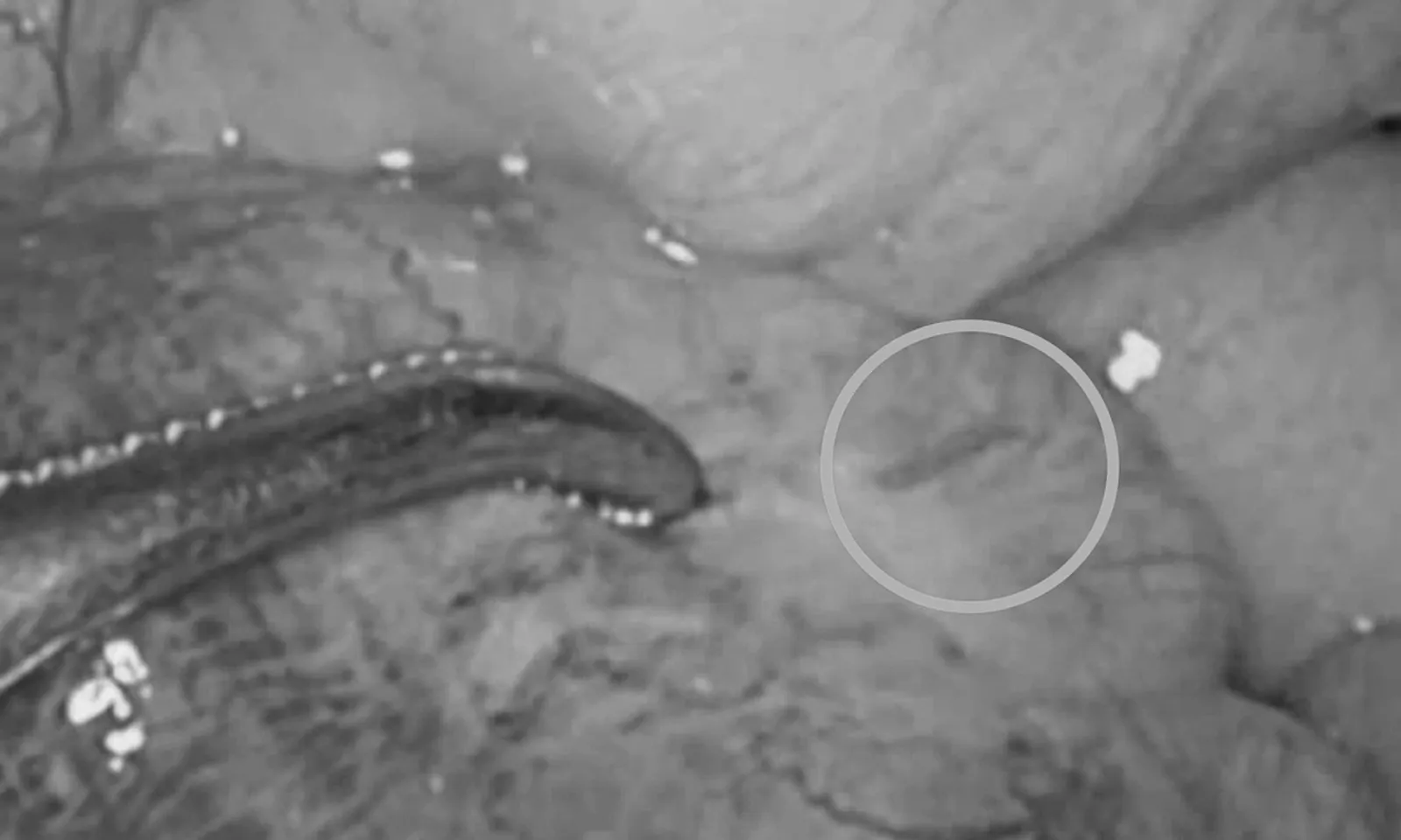 Cấp cứu thành công người đàn ông bị xương cá đâm thủng ruột