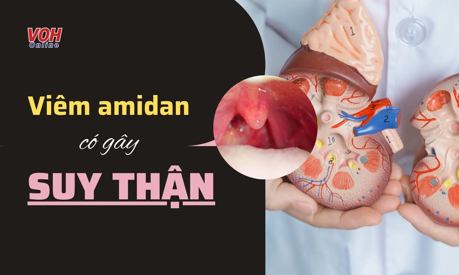 Biến chứng viêm amidan có gây suy thận, suy tim, viêm khớp?