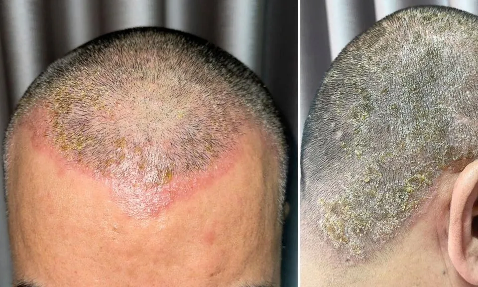 Mụn nước nổi khắp đầu sau khi nhuộm tóc