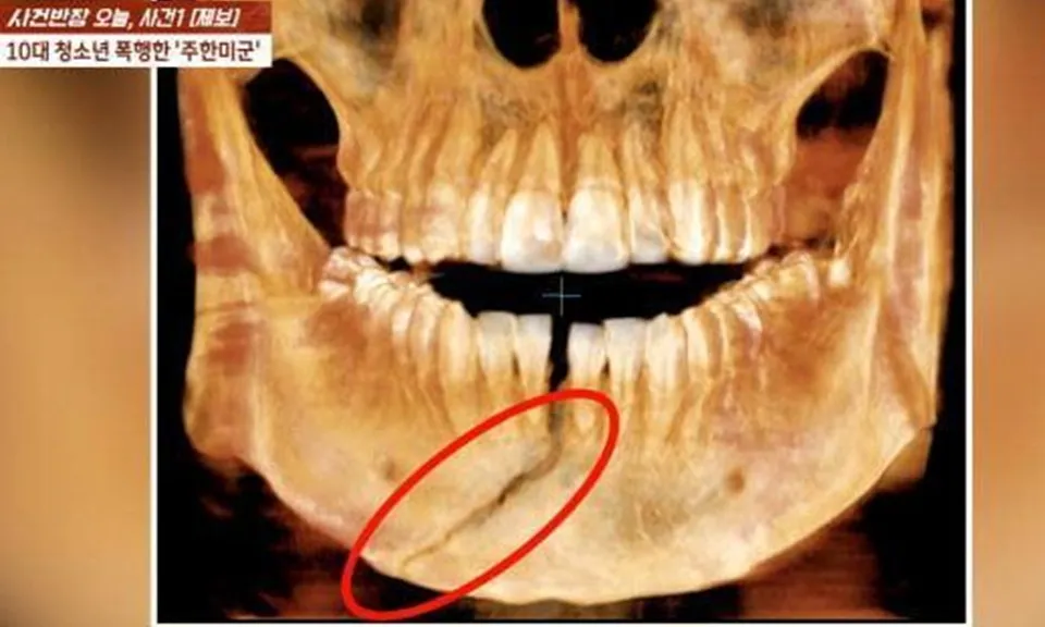 Lính Mỹ bị bắt vì đánh gãy hàm một nam sinh Hàn Quốc