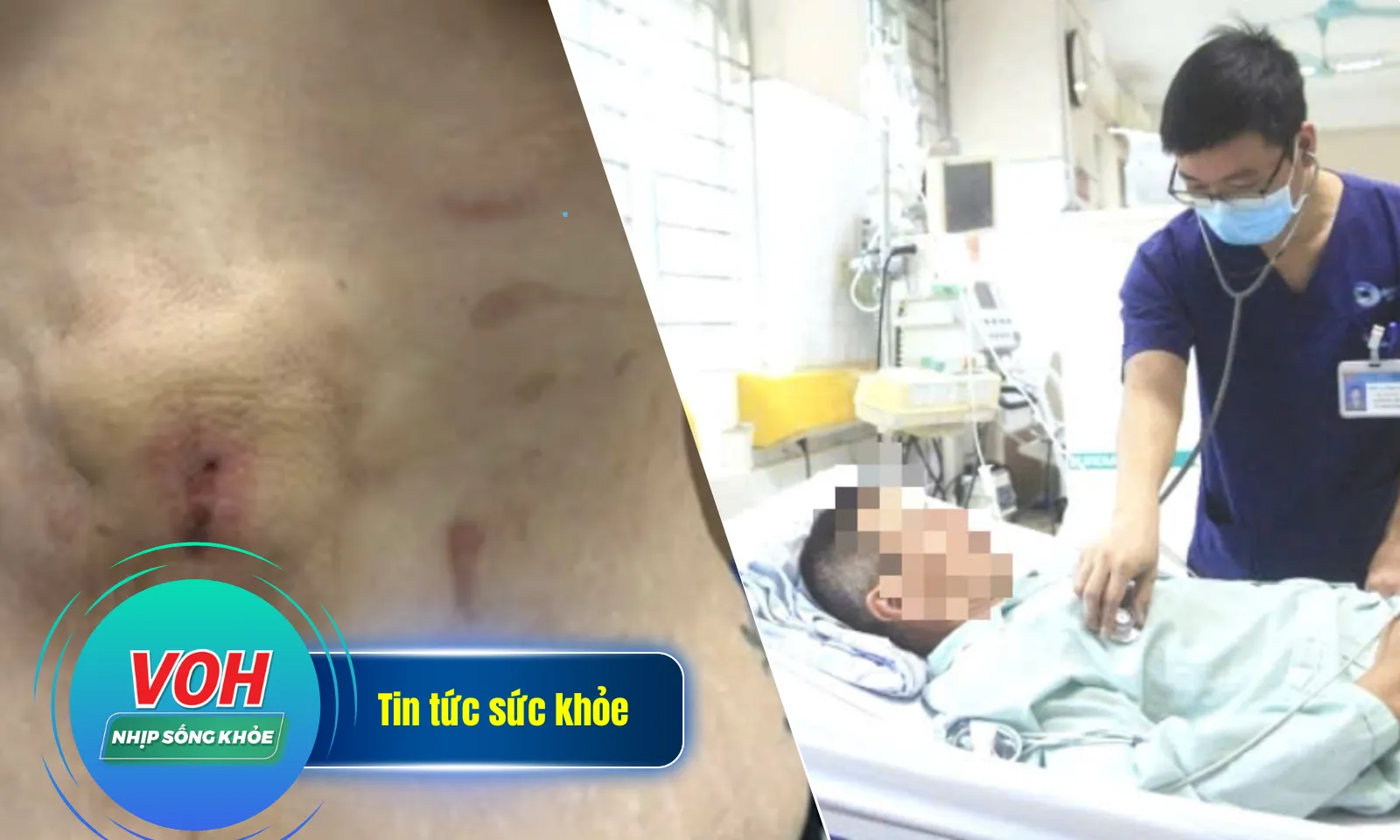 Nhịp Sống Khỏe 27/11: Nhiều người nhập viện vì ngộ độc củ ấu tàu | Biến dạng sau khi hút mỡ tạo hình