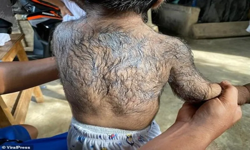Tây Ban Nha: Thuốc trị rụng tóc có thể gây hội chứng người sói ở trẻ sơ sinh