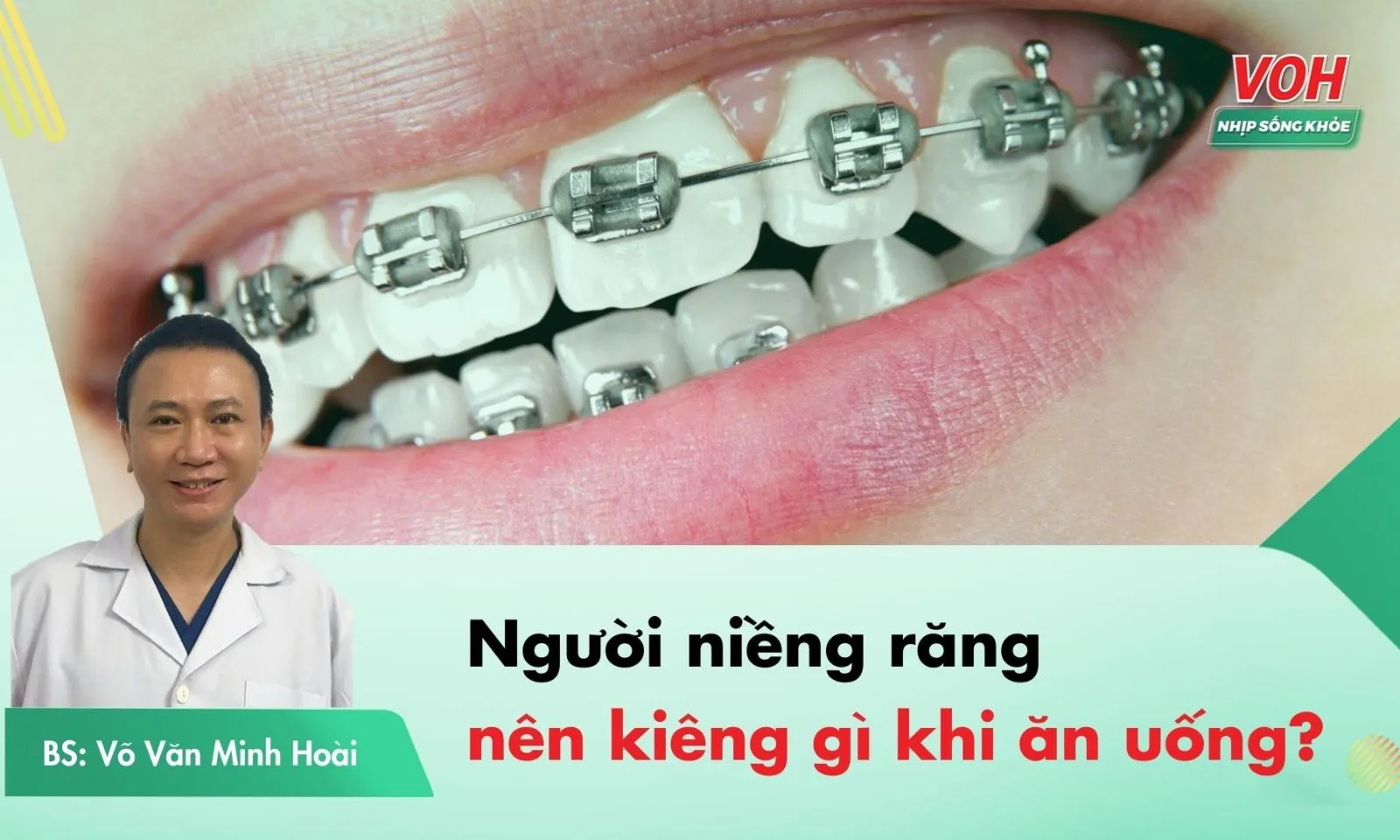 Người niềng răng nên kiêng gì khi ăn uống?