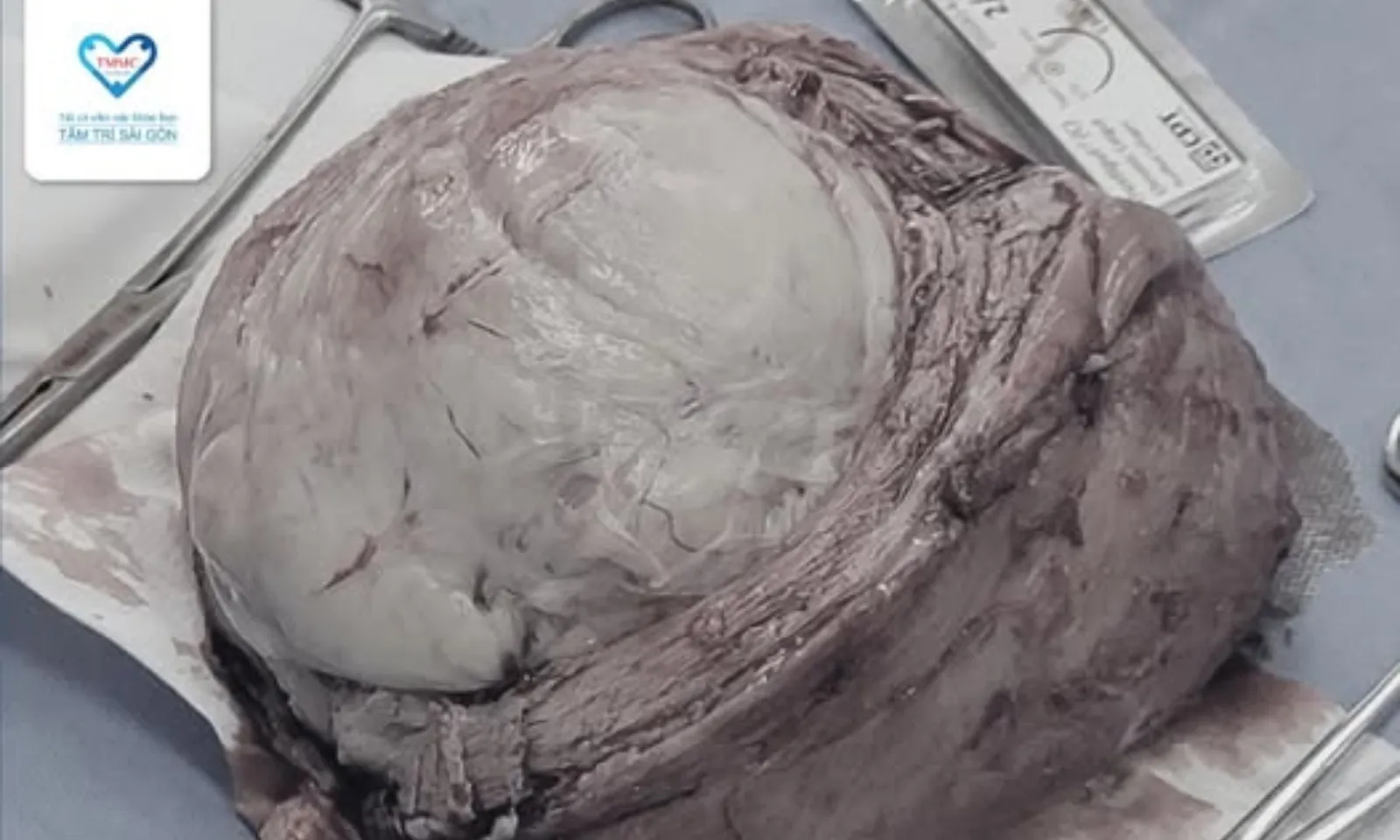 Phẫu thuật loại bỏ khối u xơ tử cung 20cm cho bệnh nhân có tình trạng rong kinh và thiếu máu 