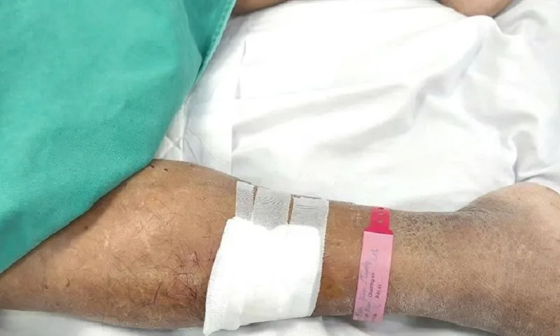 Vết xước trên da không được xử lý đúng khiến người đàn ông vào tình trạng nguy kịch