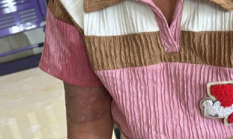 Bắt tạm giam mẹ nuôi tạt nước sôi vào bé gái vì làm mất vé số