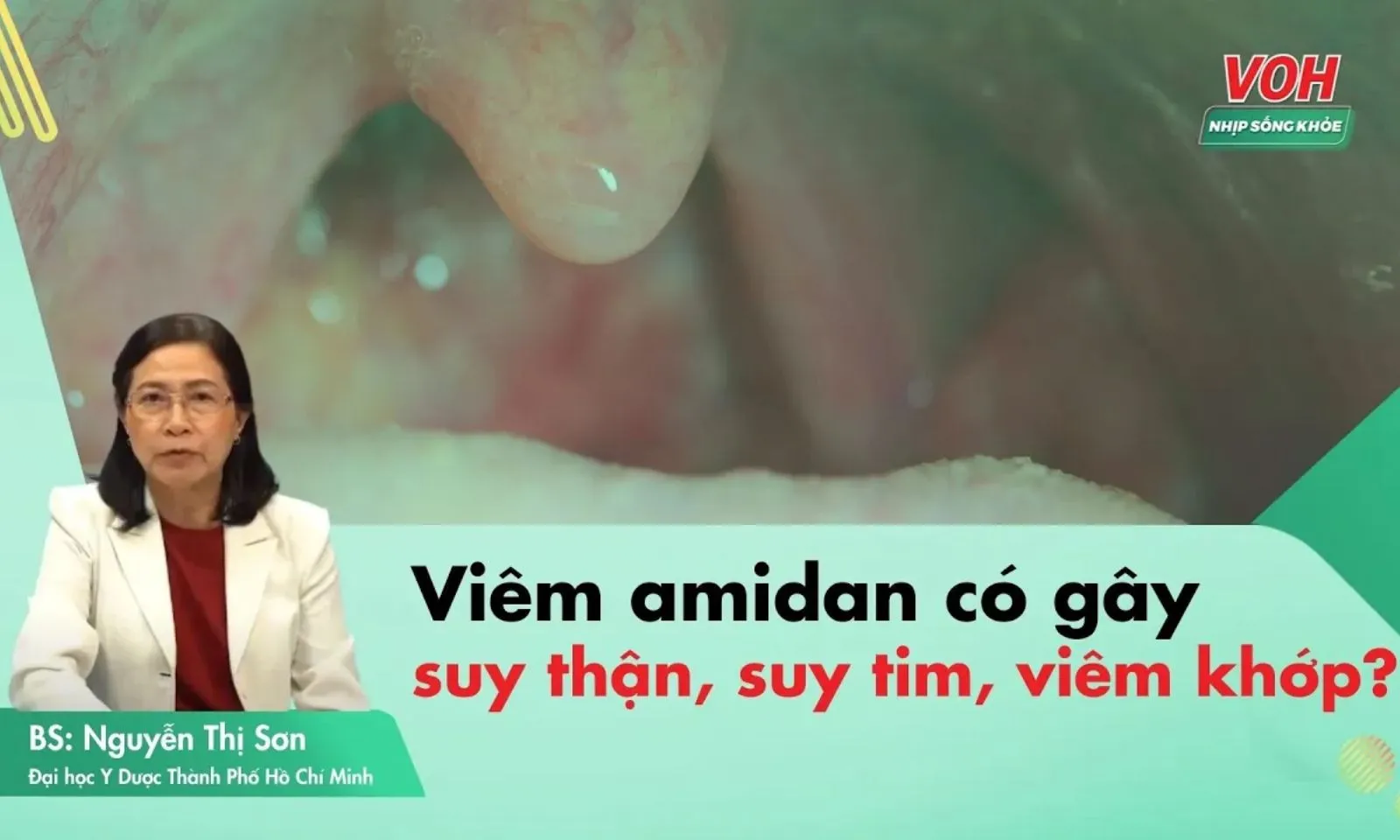 Viêm amidan có gây suy thận, suy tim, viêm khớp?