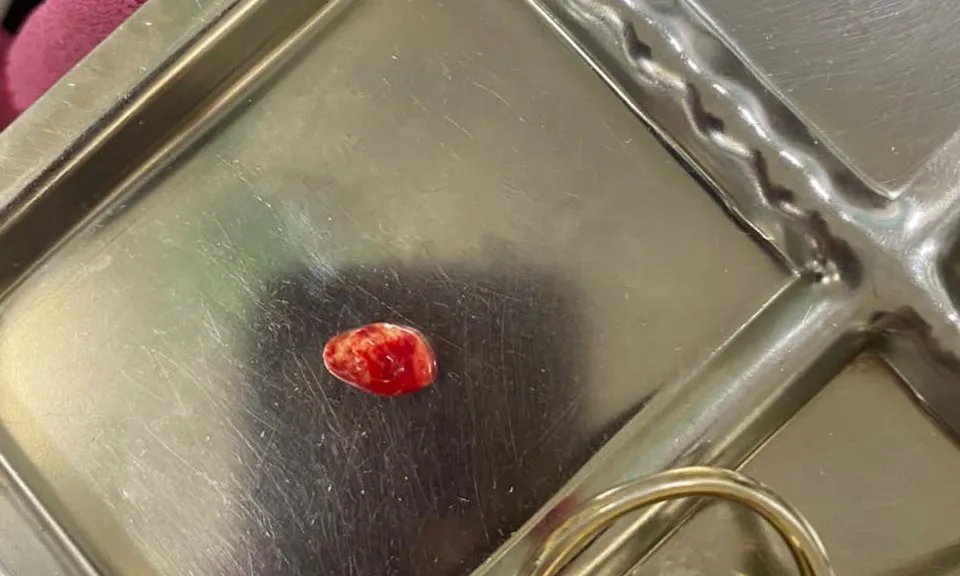 Nhận biết sớm các triệu chứng sỏi tuyến nước bọt dưới hàm