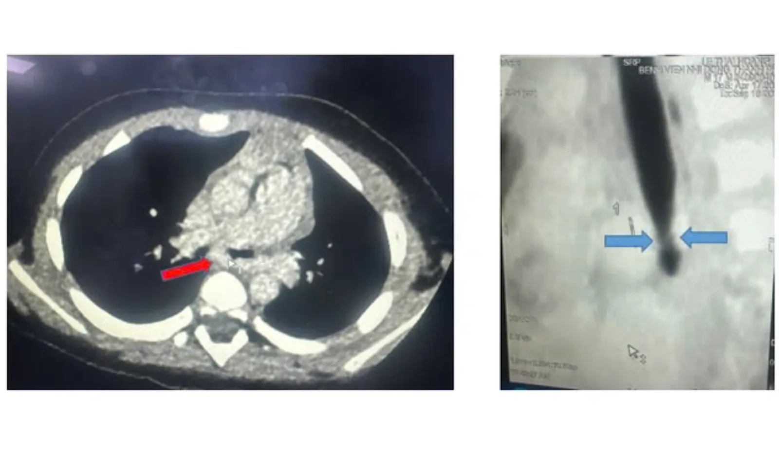 Điều trị thành công cho bé trai 20 tháng tuổi bị vòng mạch chèn ép khí phế quản