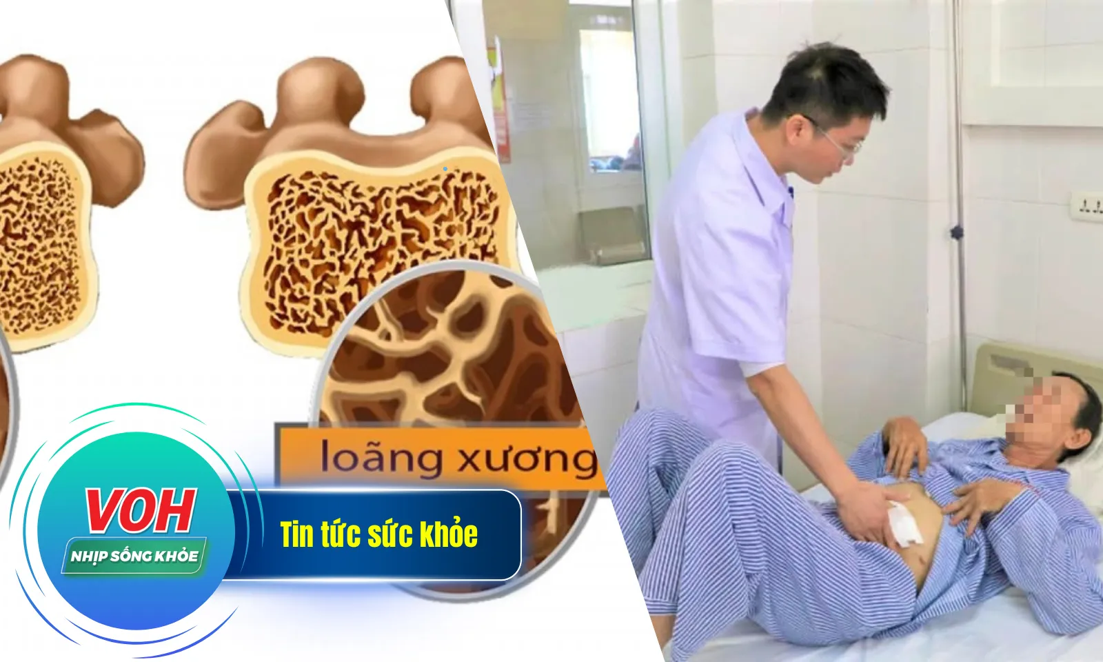 Nhịp Sống Khỏe 13/12 : 7% người trẻ tuổi bị loãng xương | Cứu người đàn ông 60 tuổi bị thủng dạ dày