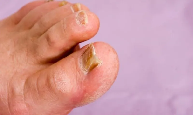 Nước súc miệng Listerine có thể trị nấm móng hiệu quả?
