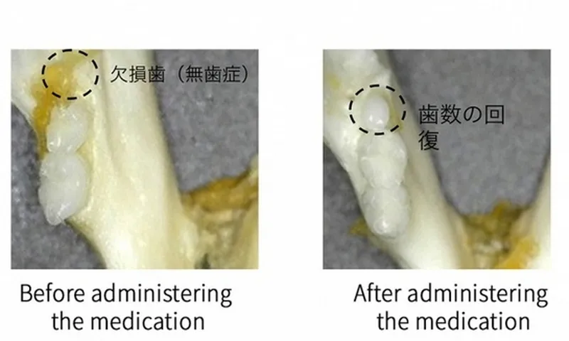 Nhật Bản thử nghiệm thuốc kích thích mọc răng mới, kỳ vọng thay thế răng giả