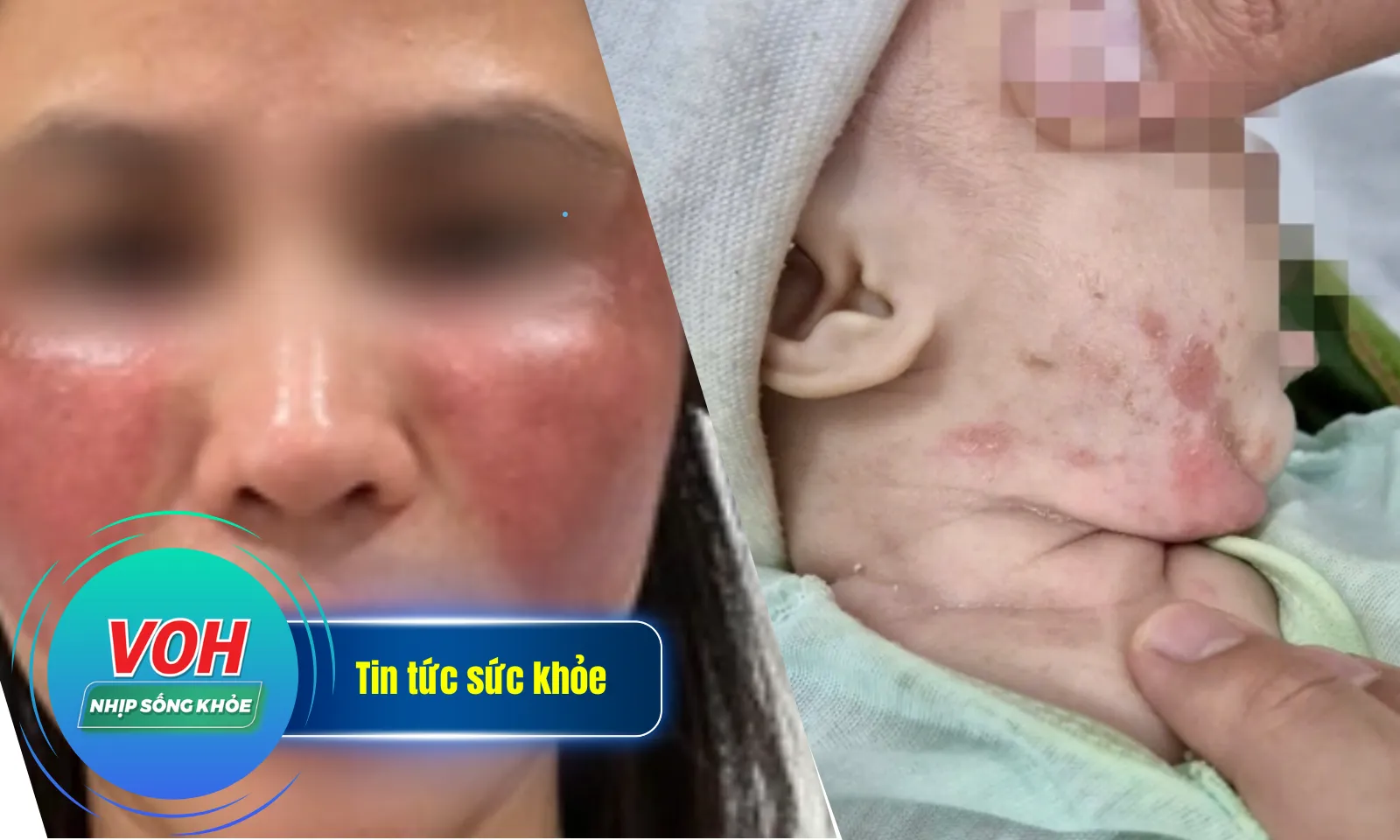 Nhịp Sống Khỏe 20/12: Bé gái vừa chào đời mắc giang mai | Bỏng mặt vì điều trị nám ở Spa để đón Tết