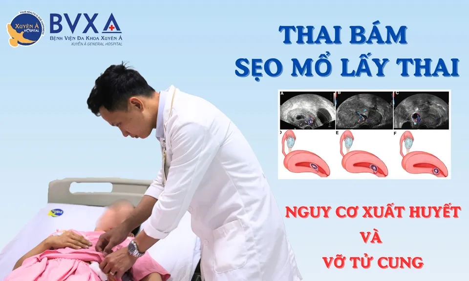 Thai bám ở sẹo mổ lấy thai, thai phụ xuất huyết, nguy cơ vỡ tử cung