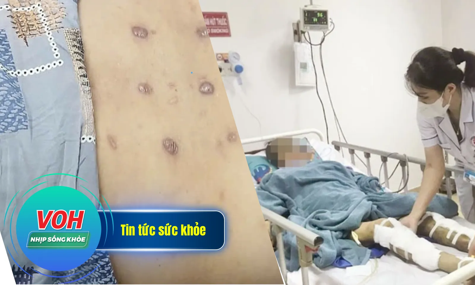 Nhịp Sống Khỏe 27/12: Báo động đỏ cứu bệnh nhân sốc đa chấn thương | Loang lổ sẹo do đốt thuốc