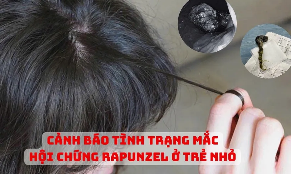 Cảnh báo tình trạng nhổ tóc, ăn tóc ở trẻ nhỏ