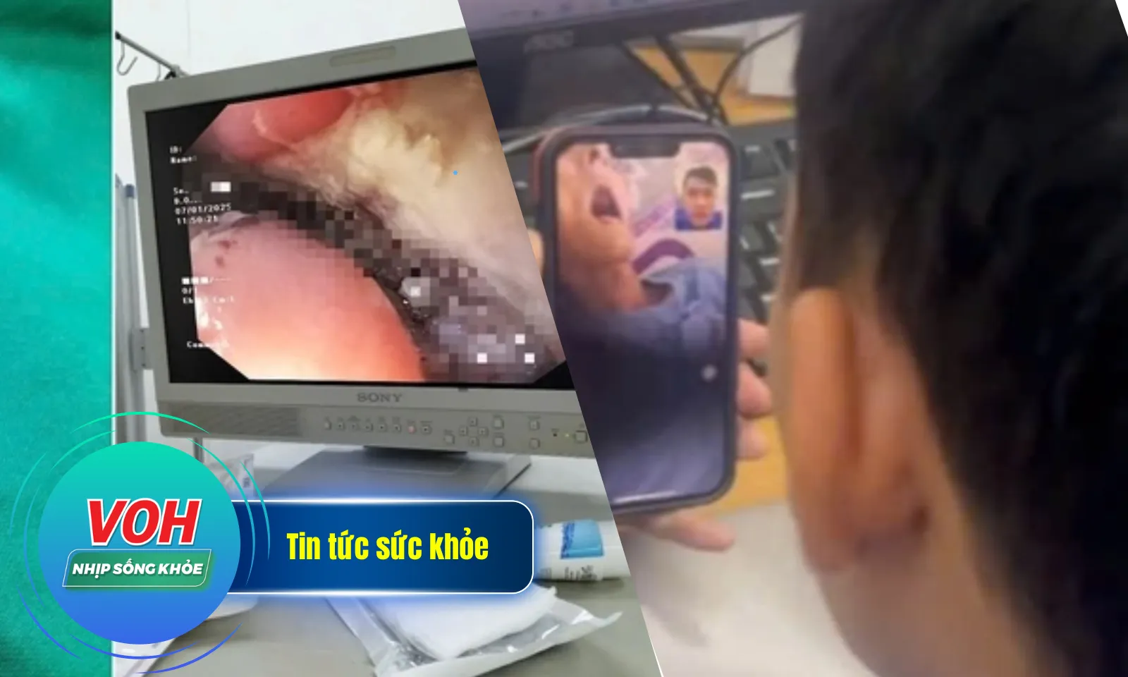 Nhịp Sống Khỏe 9/1: Gắp 3 chiếc răng giả mắc kẹt ở thực quản