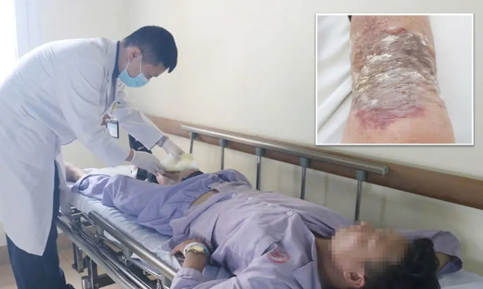 Bôi dầu nóng điều trị gãy chân, người đàn ông bị phồng rộp, nhiễm trùng da nặng