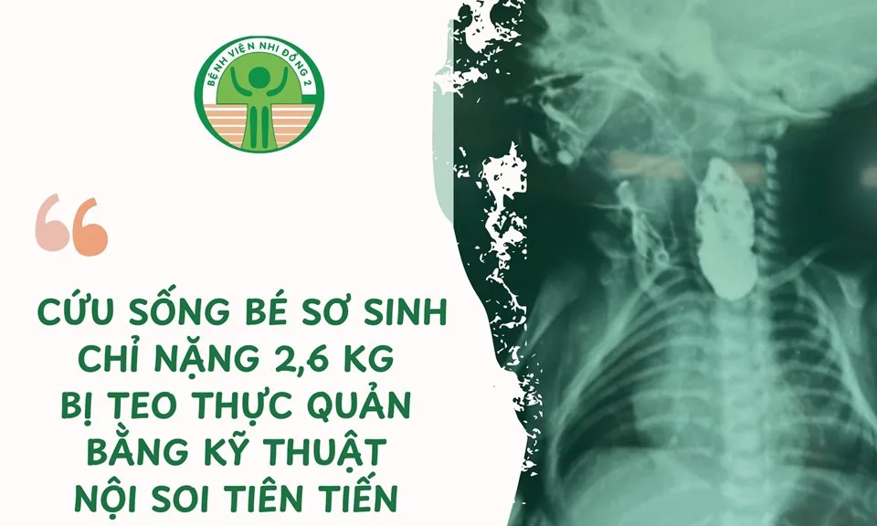 Cứu sống bé sơ sinh bị teo thực quản