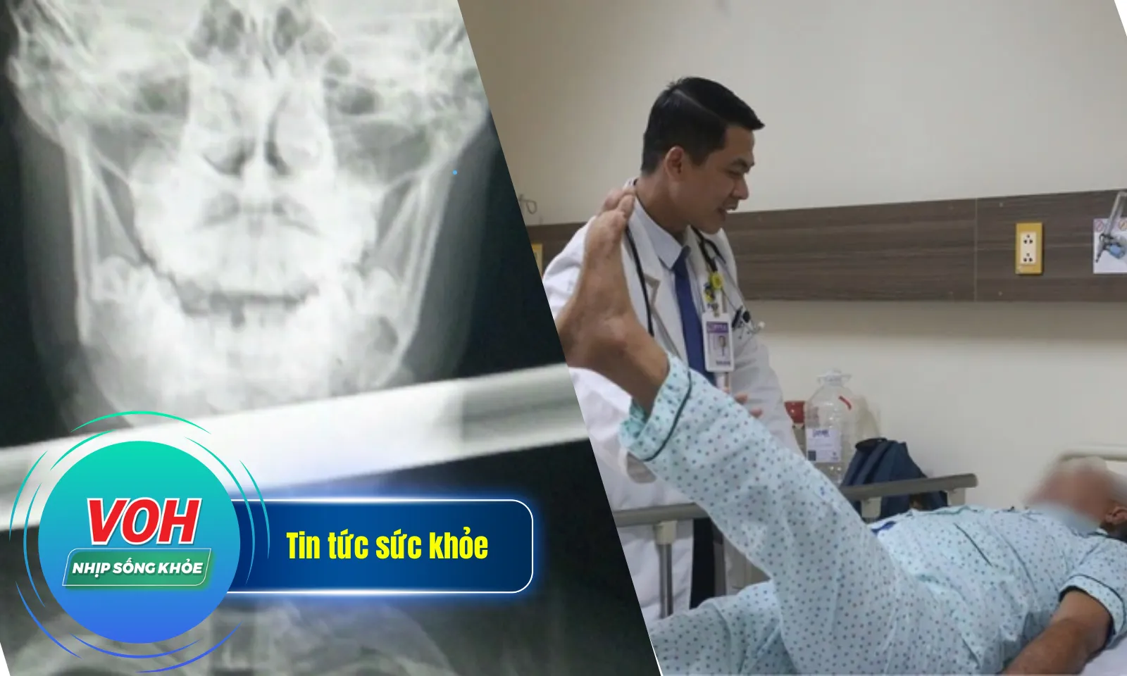 Nhịp Sống Khỏe 10/1: Sống sót thần kỳ dù bị thanh sắt đâm xuyên cổ | Phát hiện đột quỵ khi thức giấc